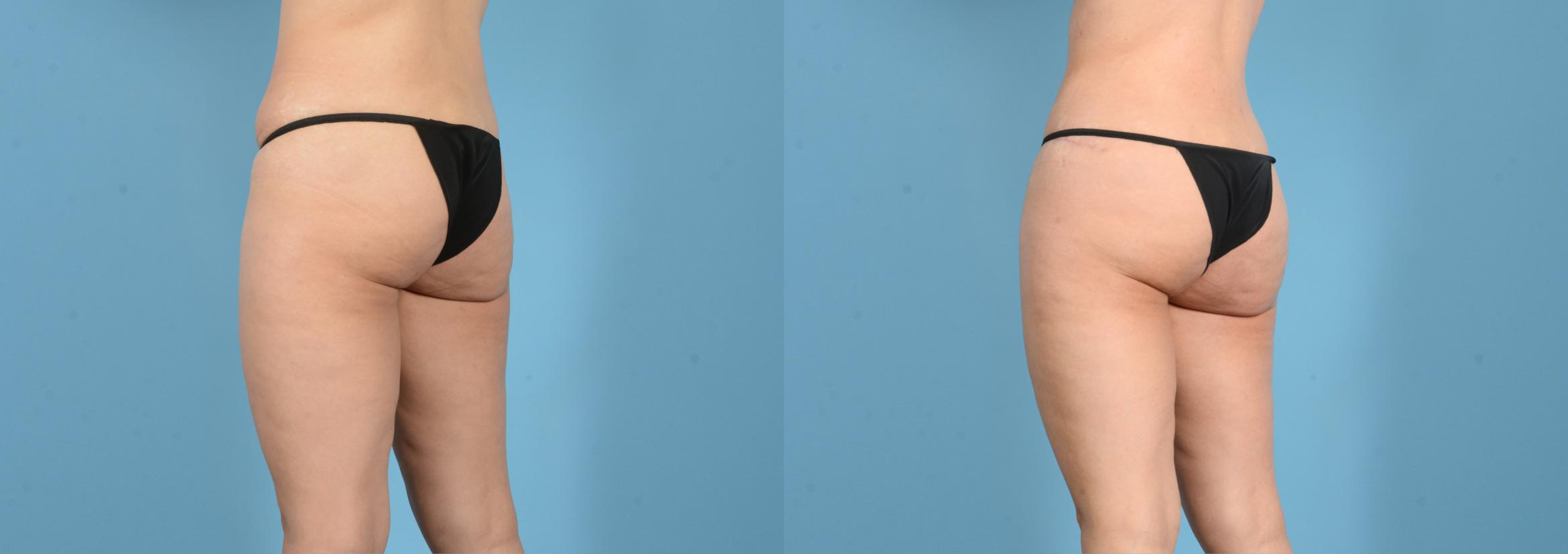 Before & After Brazilian Butt Lift Case 18160 Left Oblique (Back) View in Houston, TX