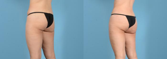 Before & After Brazilian Butt Lift Case 18160 Left Oblique (Back) View in Houston, TX