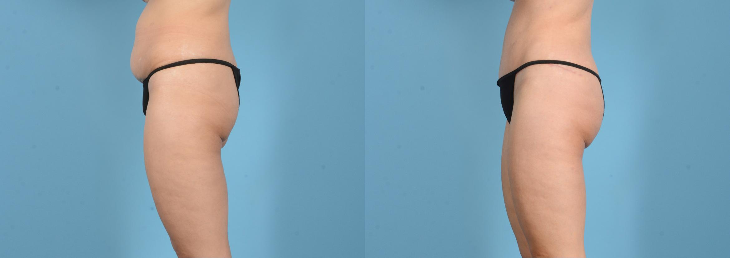 Before & After Brazilian Butt Lift Case 18160 Left Side View in Houston, TX