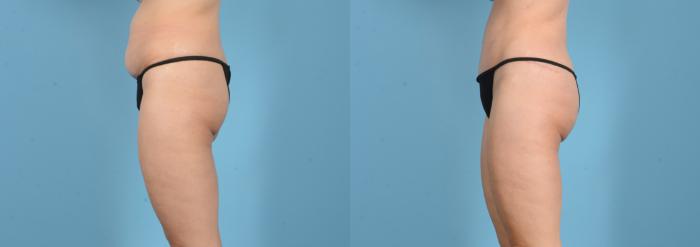 Before & After Brazilian Butt Lift Case 18160 Left Side View in Houston, TX