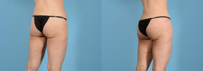 Before & After Brazilian Butt Lift Case 18160 Right Oblique (Back) View in Houston, TX