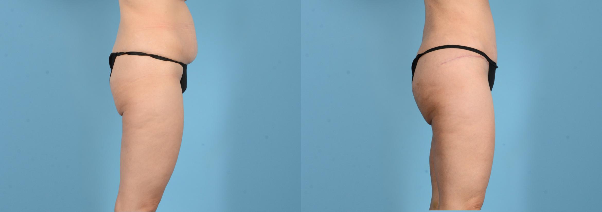 Before & After Brazilian Butt Lift Case 18160 Right Side View in Houston, TX