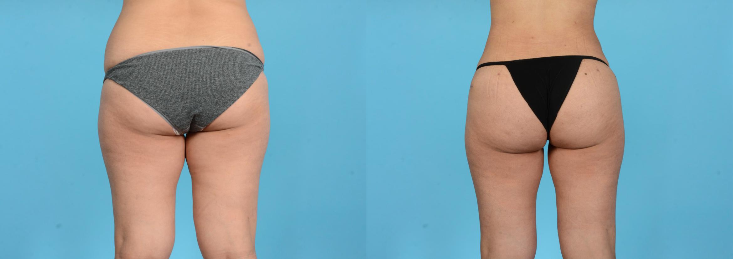 Before & After Brazilian Butt Lift Case 18165 Back View in Houston, TX