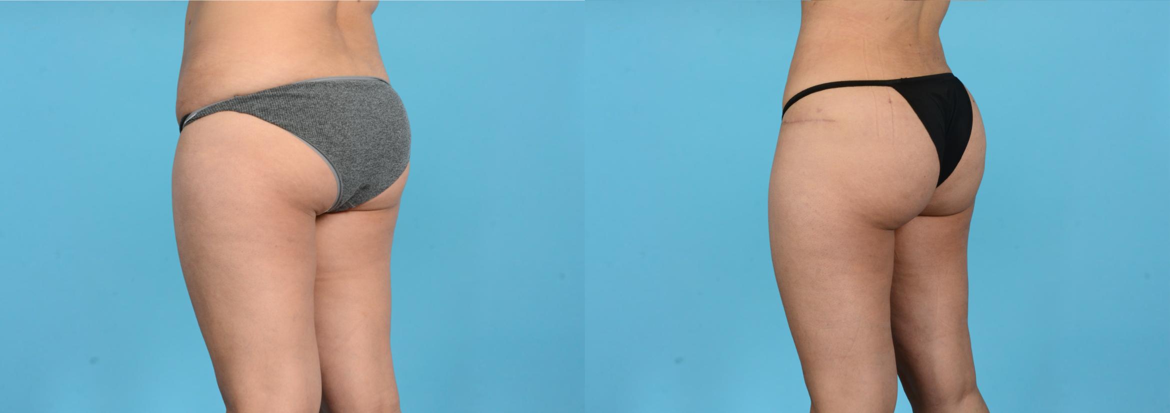 Before & After Brazilian Butt Lift Case 18165 Left Oblique (Back) View in Houston, TX