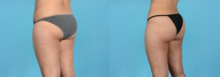 Before & After Brazilian Butt Lift Case 18165 Left Oblique (Back) View in Houston, TX