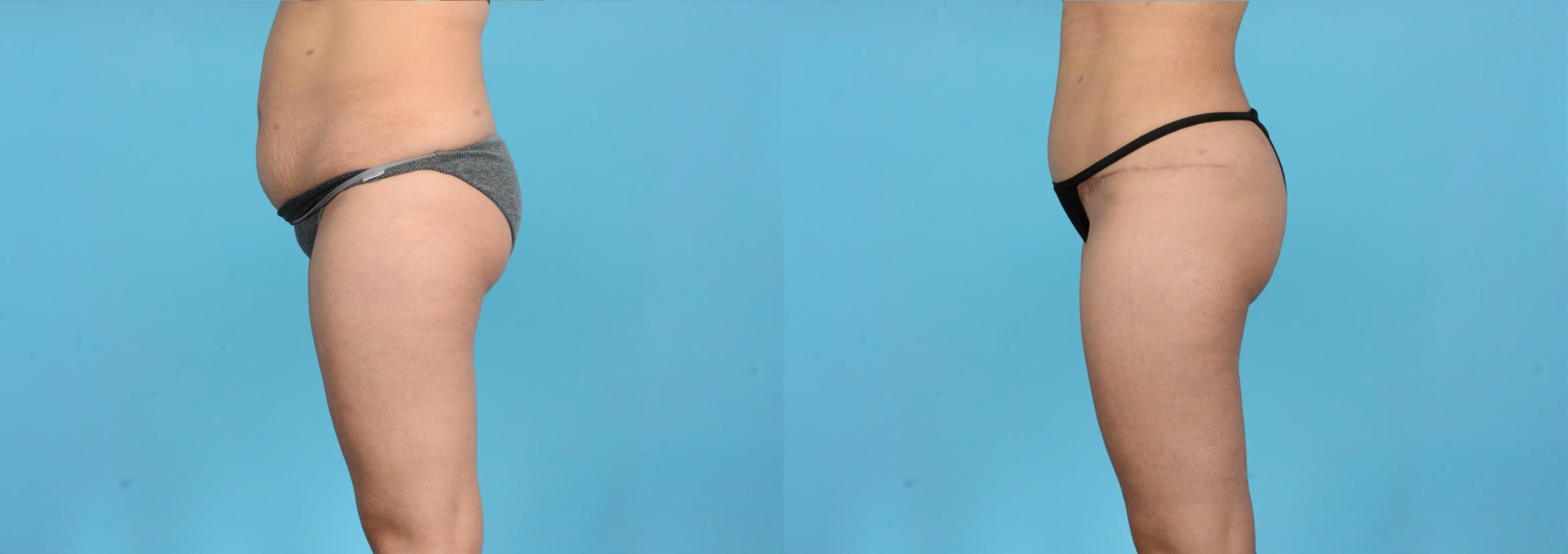 Before & After Brazilian Butt Lift Case 18165 Left Side View in Houston, TX