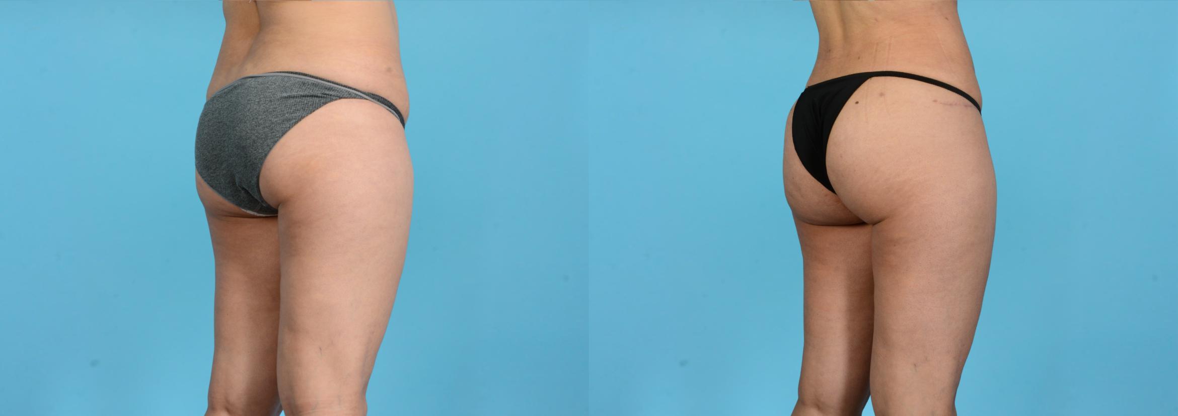 Before & After Brazilian Butt Lift Case 18165 Right Oblique (Back) View in Houston, TX
