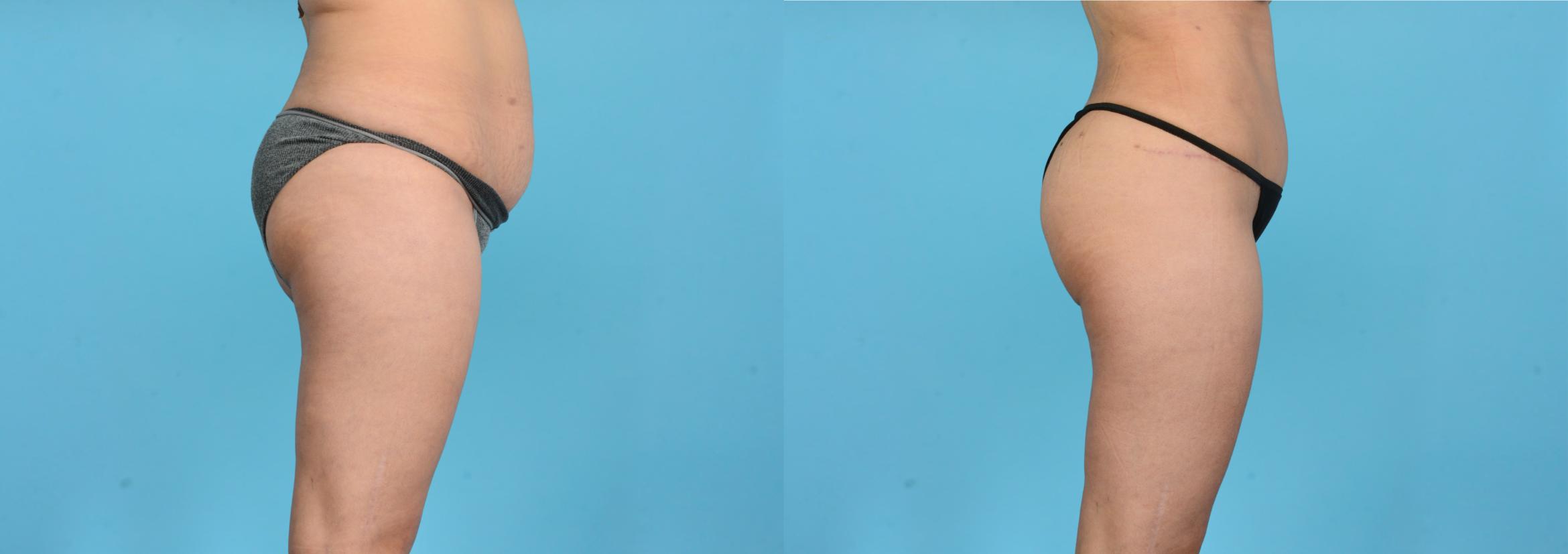 Before & After Brazilian Butt Lift Case 18165 Right Side View in Houston, TX