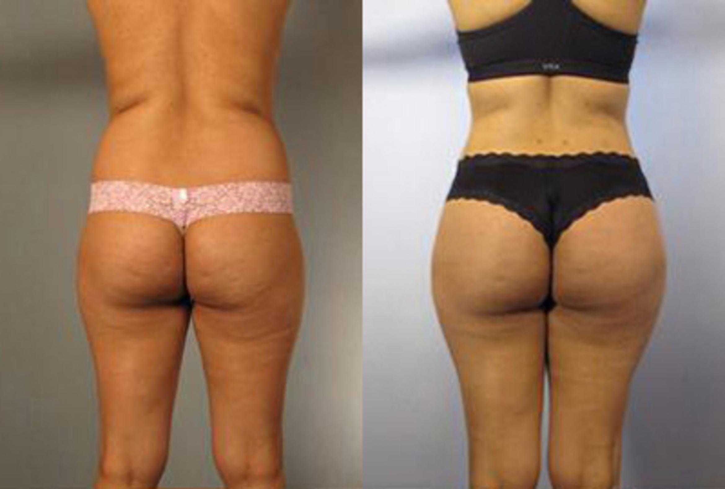 Before & After Brazilian Butt Lift Case 2977 View 1 View in Houston, TX