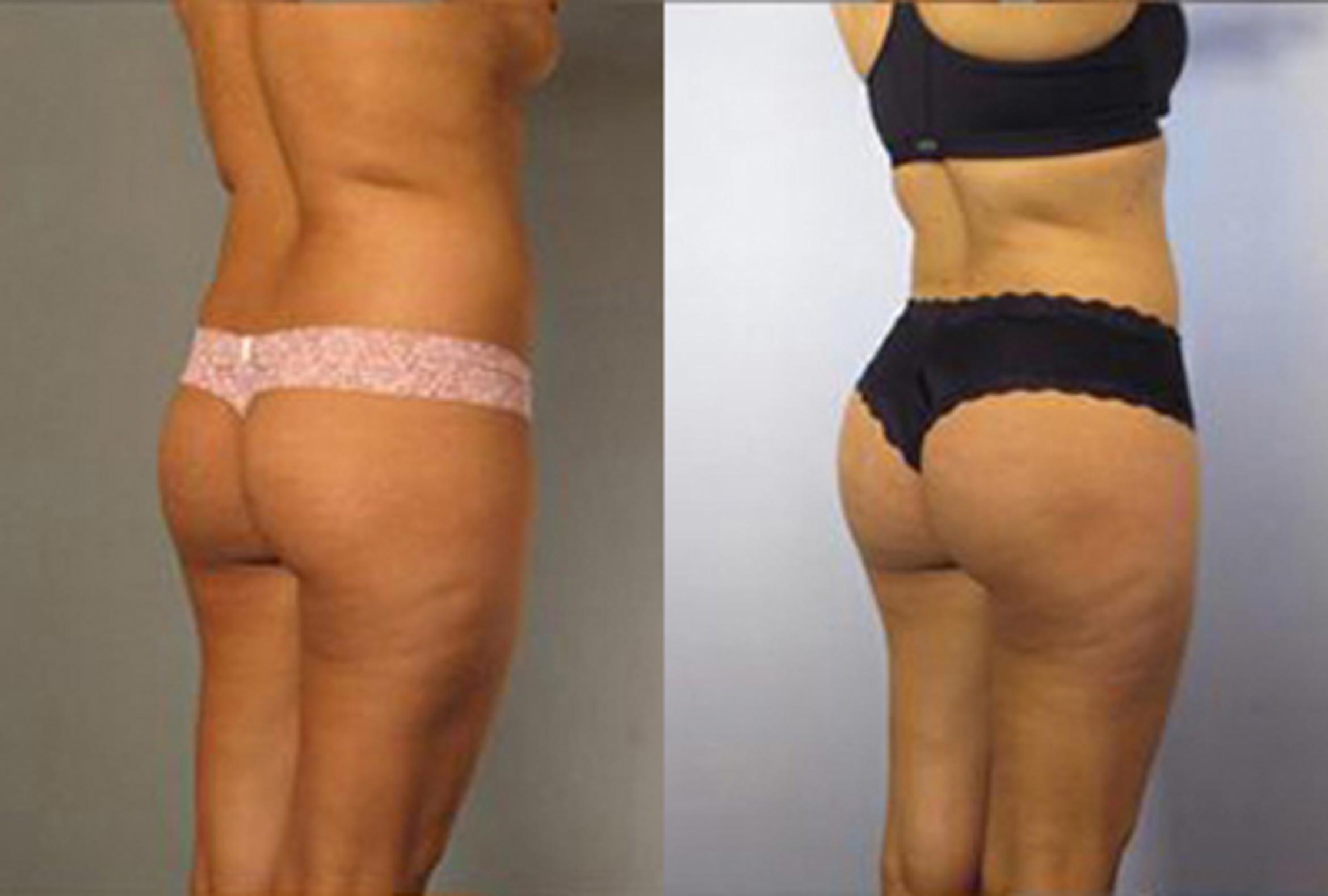 Before & After Brazilian Butt Lift Case 2977 View 2 View in Houston, TX