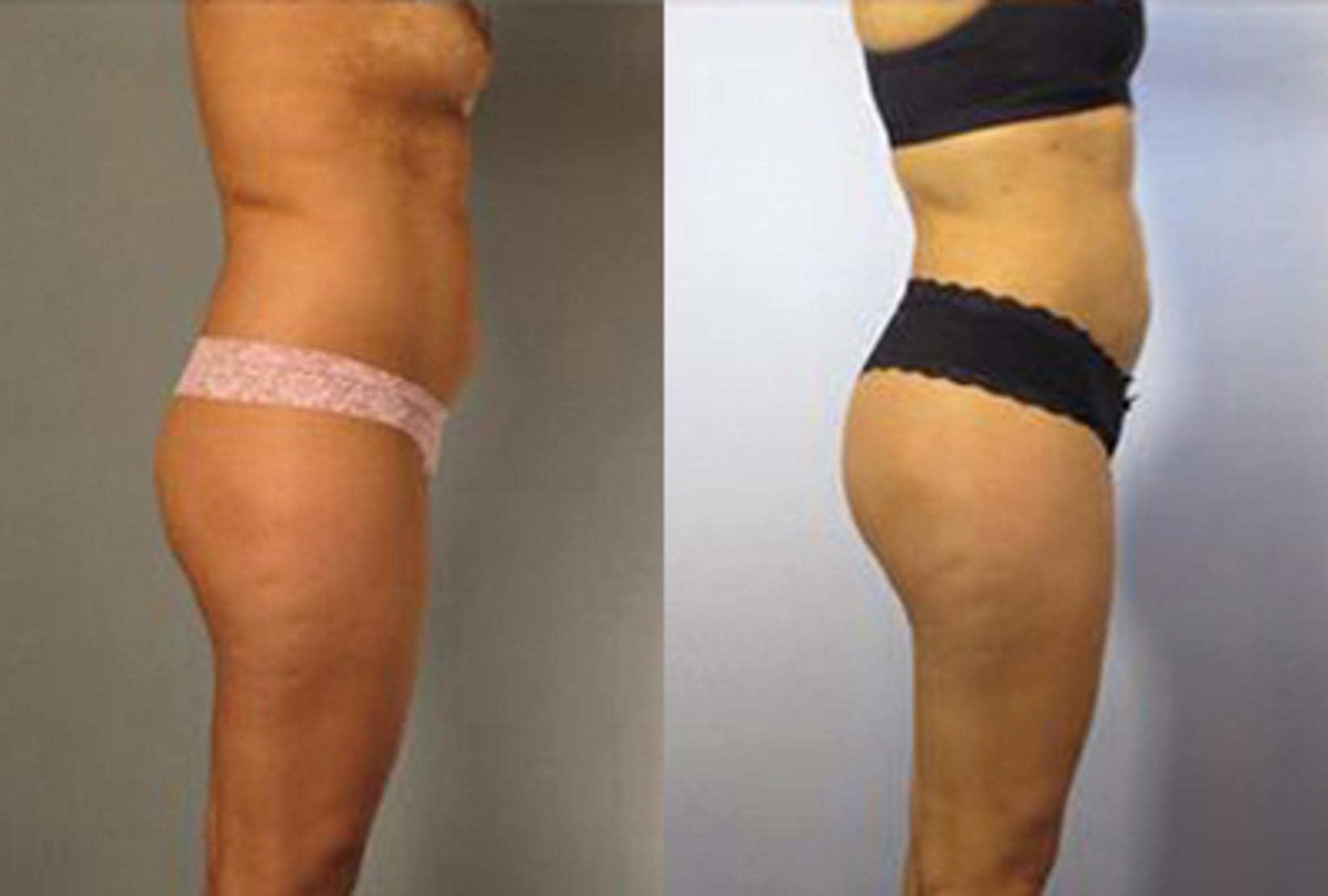 Before & After Brazilian Butt Lift Case 2977 View 3 View in Houston, TX