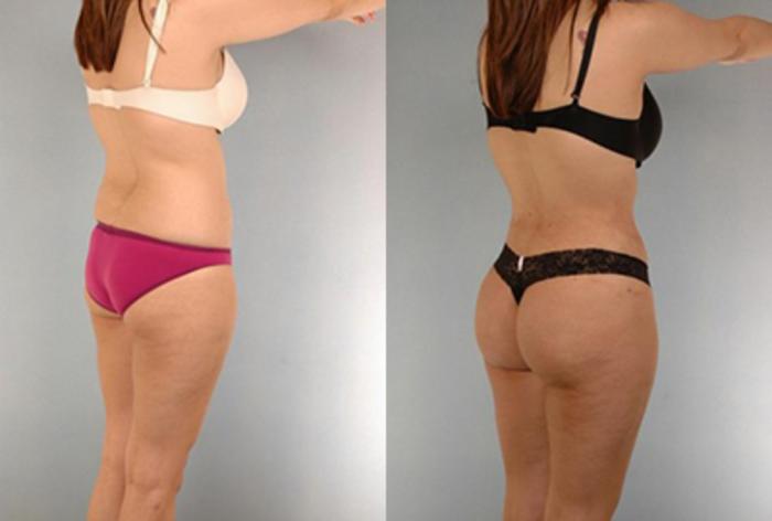 Before & After Brazilian Butt Lift Case 2985 View 1 View in Houston, TX