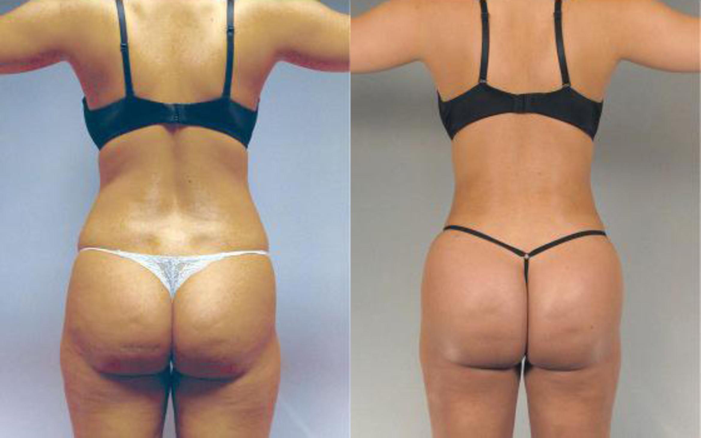 Before & After Brazilian Butt Lift Case 2989 View 1 View in Houston, TX