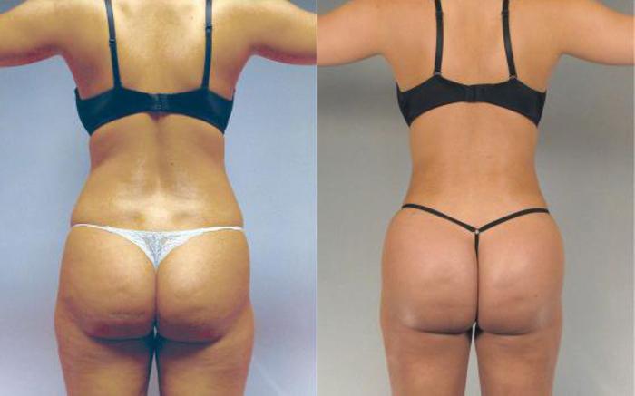 Before & After Brazilian Butt Lift Case 2989 View 1 View in Houston, TX