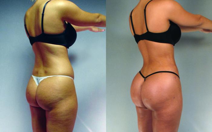 Before & After Brazilian Butt Lift Case 2989 View 2 View in Houston, TX