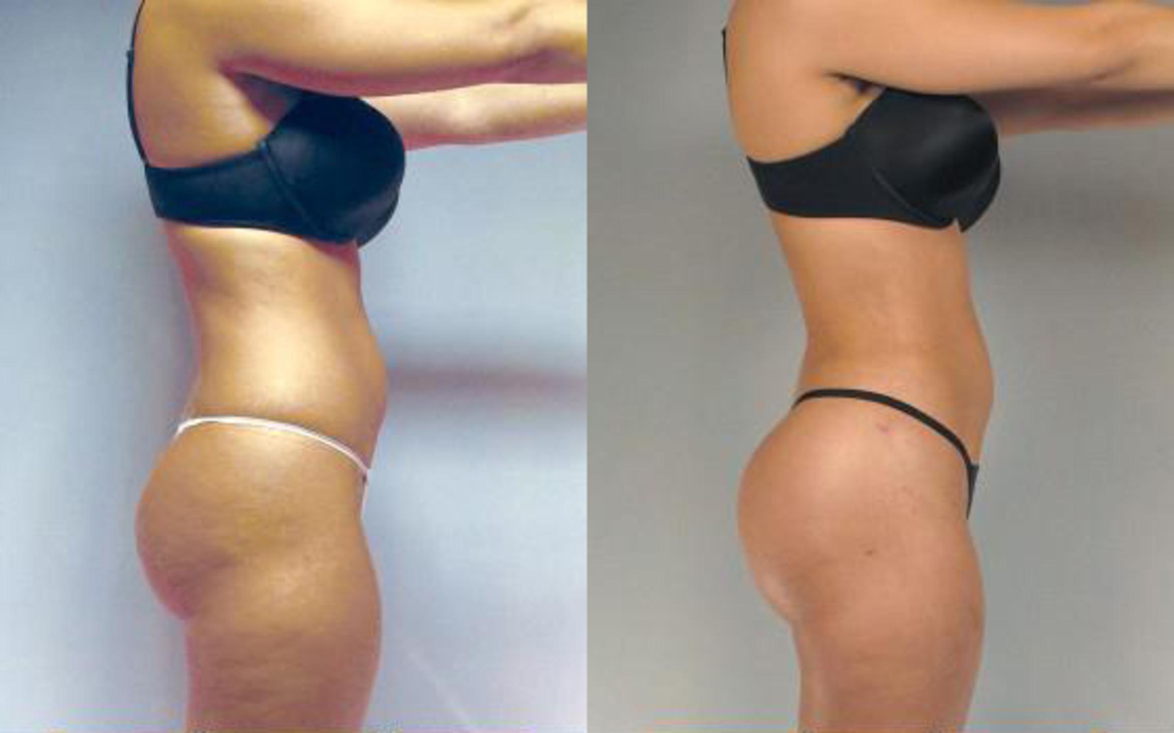 Before & After Brazilian Butt Lift Case 2989 View 3 View in Houston, TX