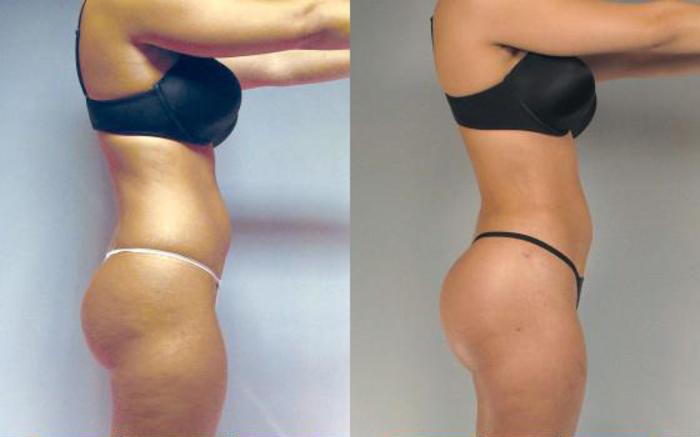 Before & After Brazilian Butt Lift Case 2989 View 3 View in Houston, TX