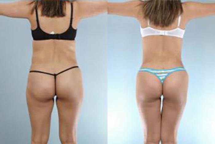 Before & After Brazilian Butt Lift Case 2995 View 1 View in Houston, TX