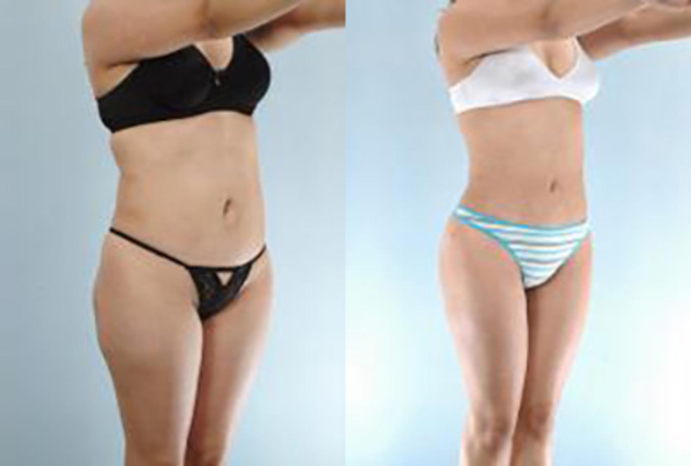 Before & After Brazilian Butt Lift Case 2995 View 2 View in Houston, TX