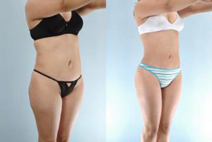 Before & After Brazilian Butt Lift Case 2995 View 2 View in Houston, TX