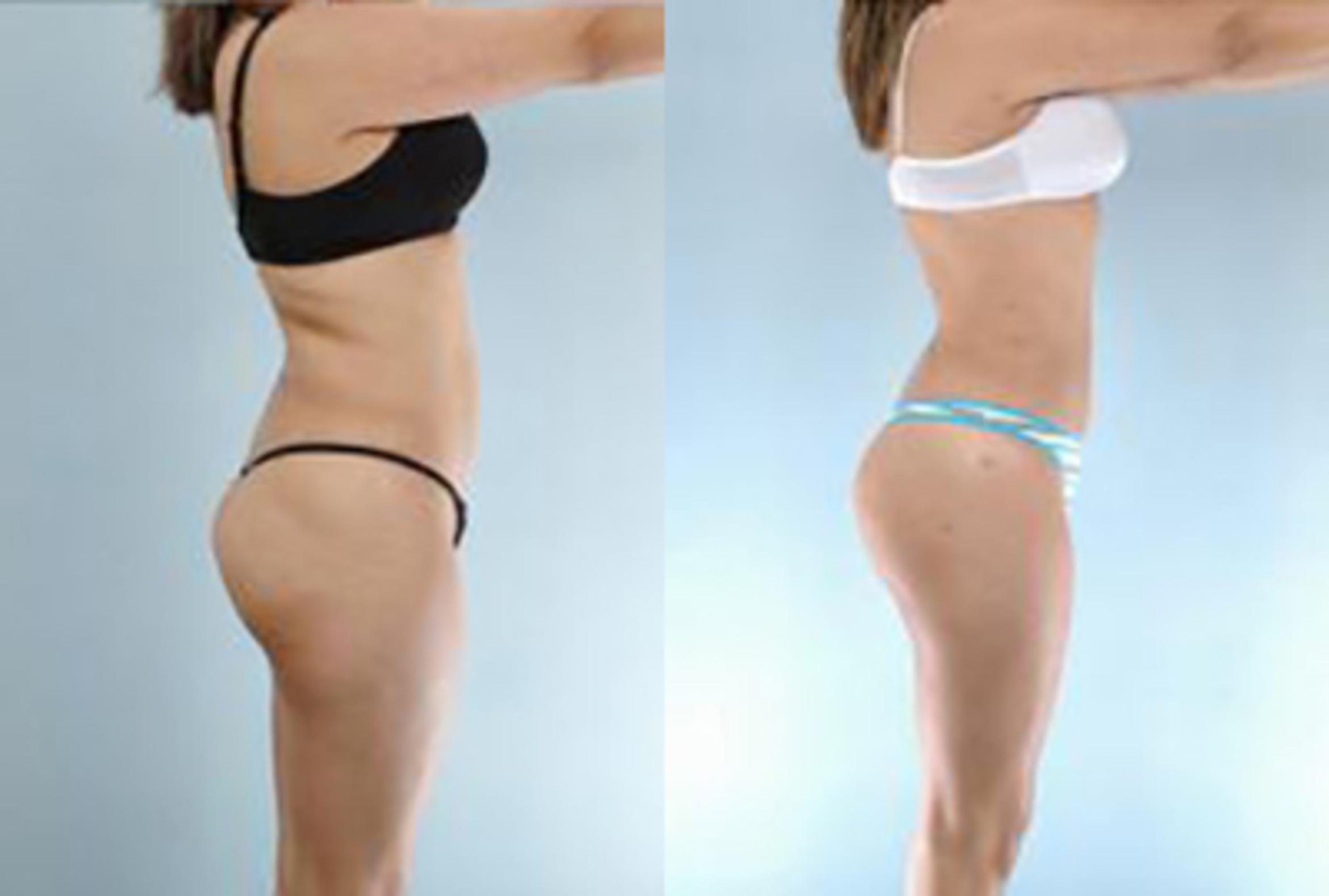 Before & After Brazilian Butt Lift Case 2995 View 3 View in Houston, TX