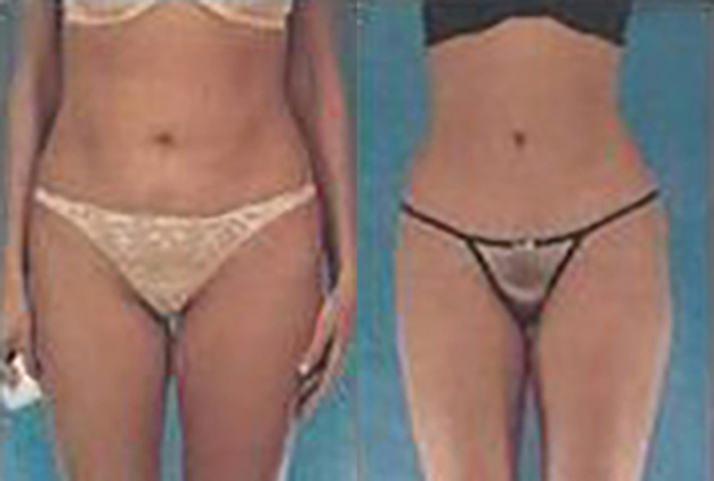 Before & After Brazilian Butt Lift Case 3003 View 1 View in Houston, TX