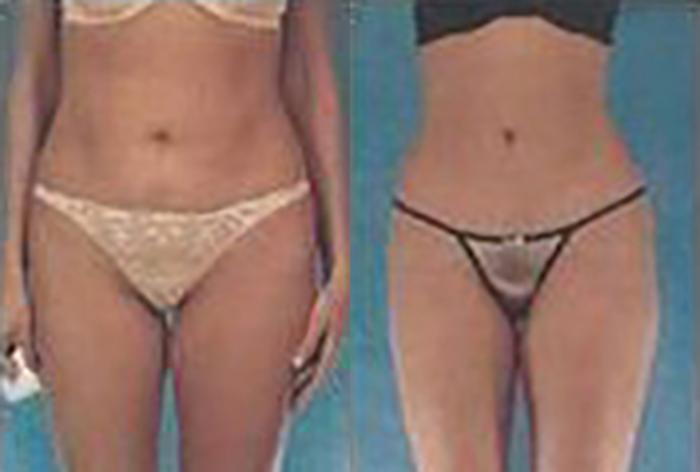 Before & After Brazilian Butt Lift Case 3003 View 1 View in Houston, TX