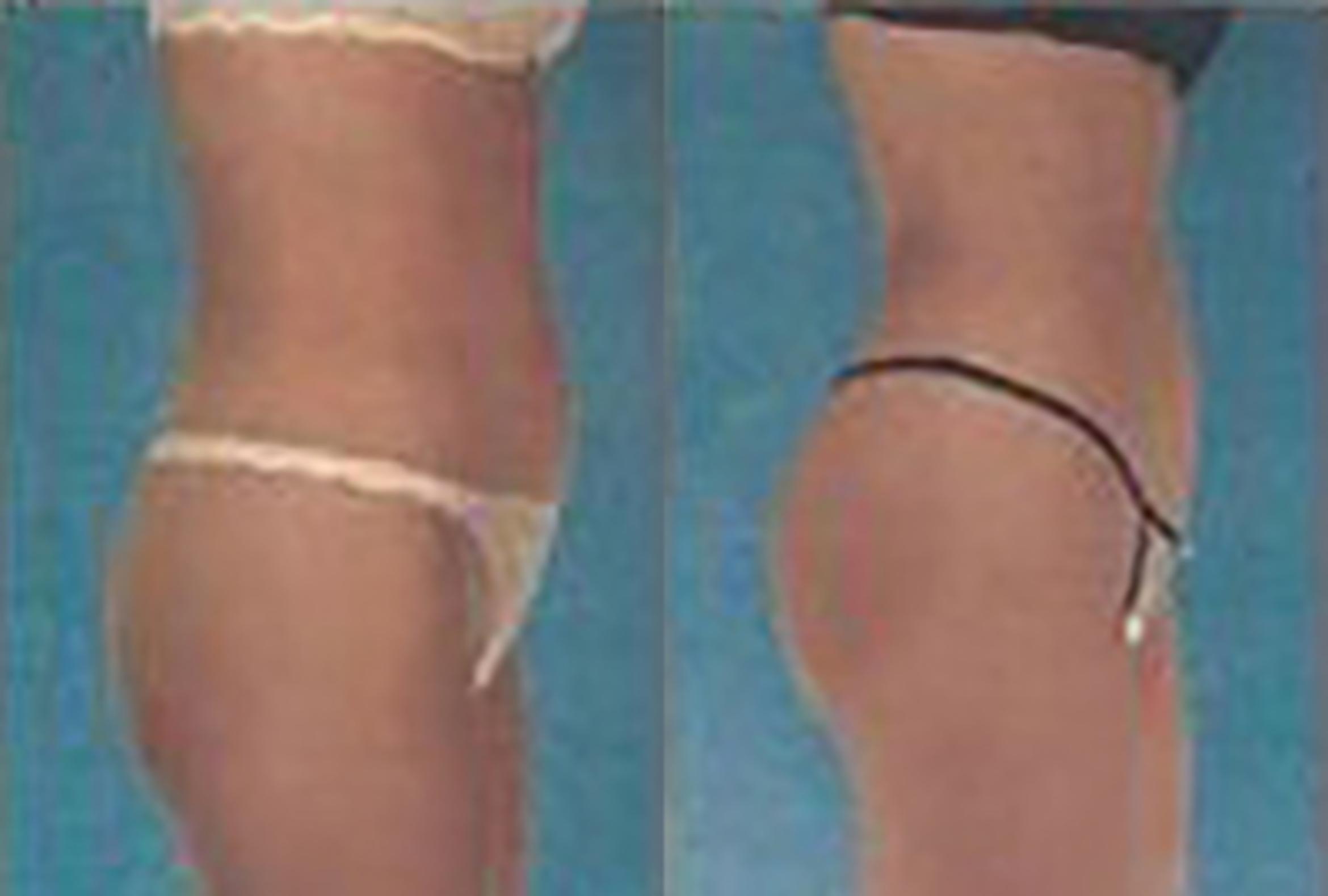 Before & After Brazilian Butt Lift Case 3003 View 2 View in Houston, TX