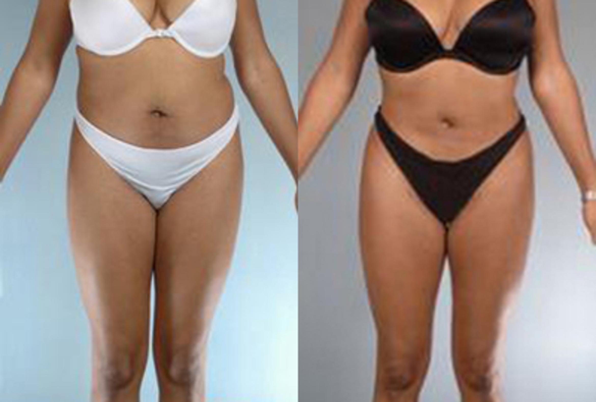 Before & After Brazilian Butt Lift Case 3009 View 1 View in Houston, TX