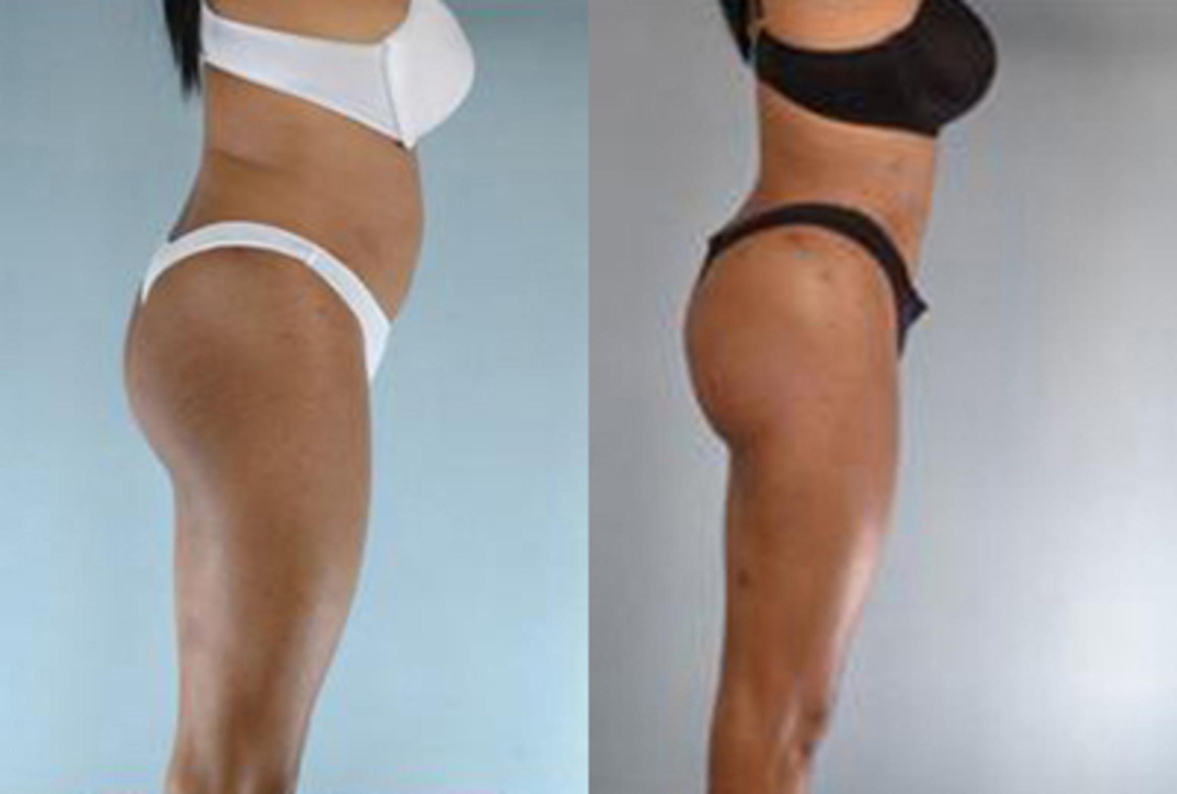 Before & After Brazilian Butt Lift Case 3009 View 2 View in Houston, TX
