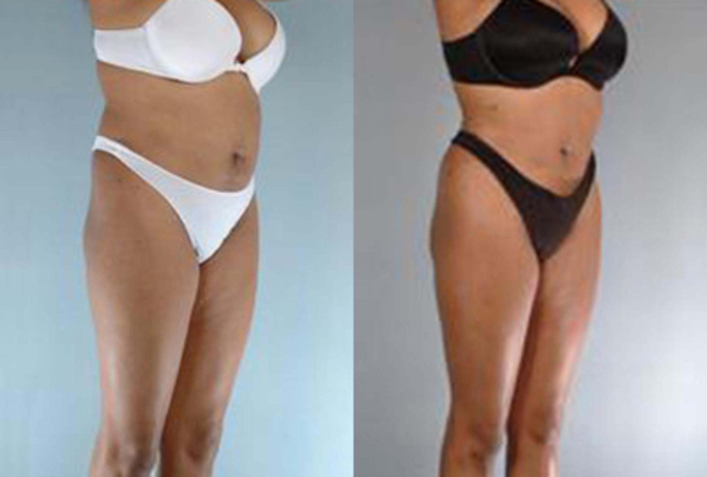 Before & After Brazilian Butt Lift Case 3009 View 3 View in Houston, TX