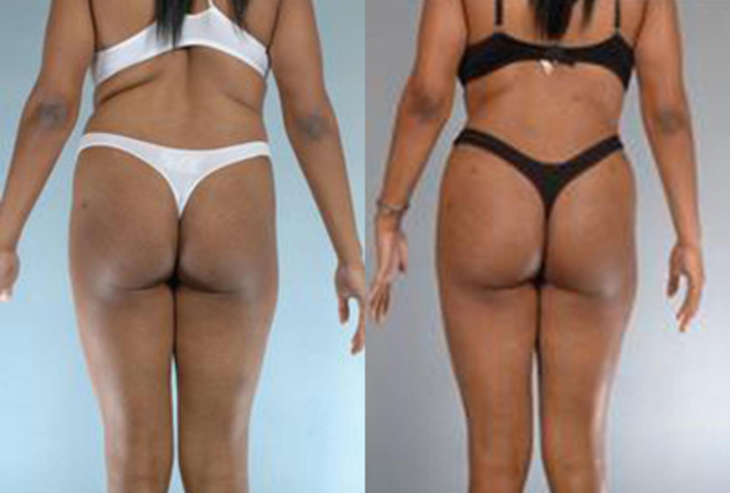 Before & After Brazilian Butt Lift Case 3009 View 4 View in Houston, TX