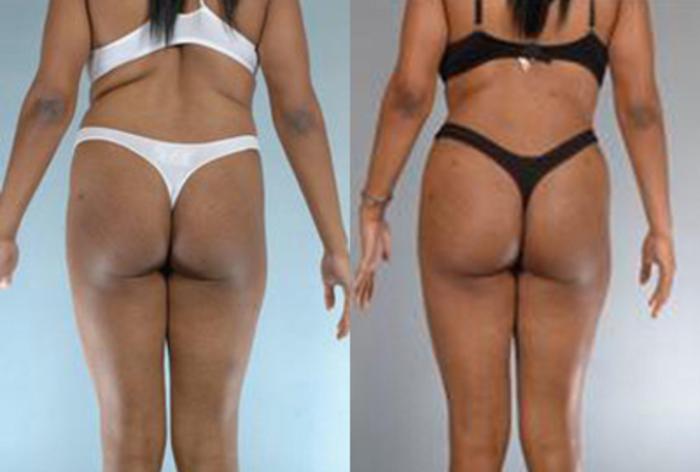 Before & After Brazilian Butt Lift Case 3009 View 4 View in Houston, TX