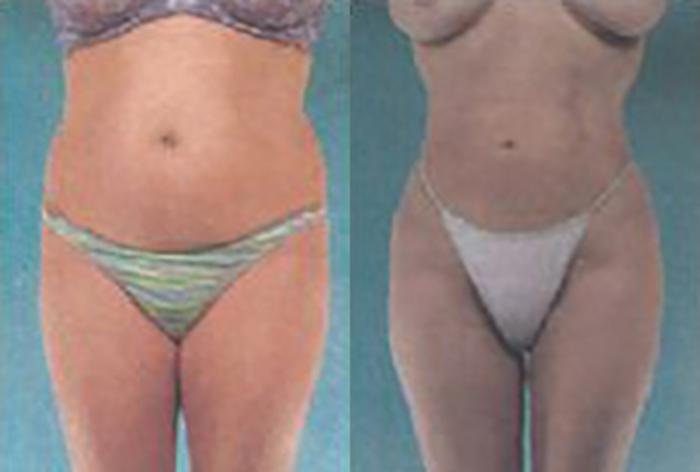 Before & After Brazilian Butt Lift Case 3022 View 1 View in Houston, TX
