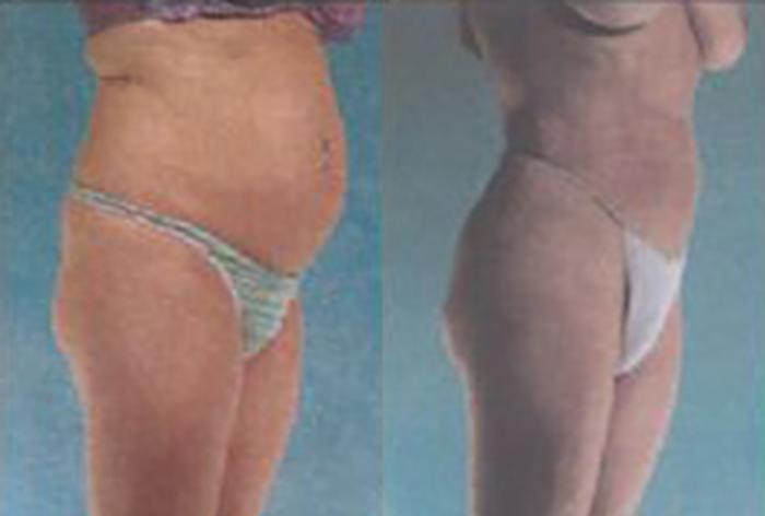Before & After Brazilian Butt Lift Case 3022 View 2 View in Houston, TX