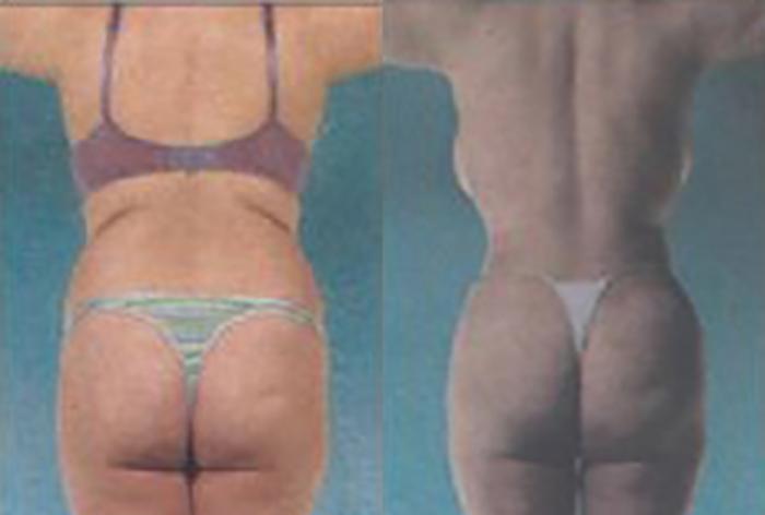 Before & After Brazilian Butt Lift Case 3022 View 3 View in Houston, TX