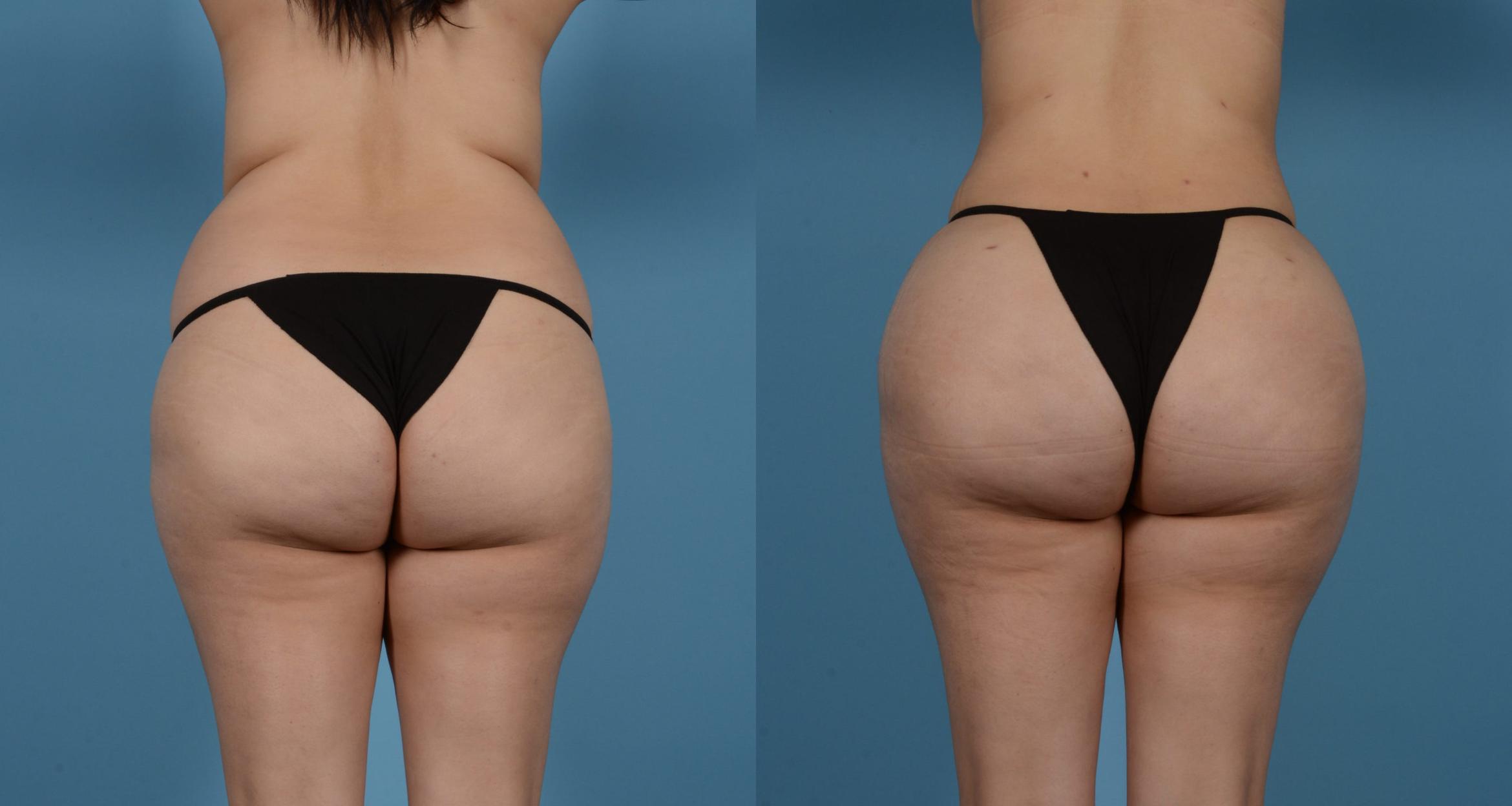 Before & After Brazilian Butt Lift Case 61387520 View 1 View in Houston, TX