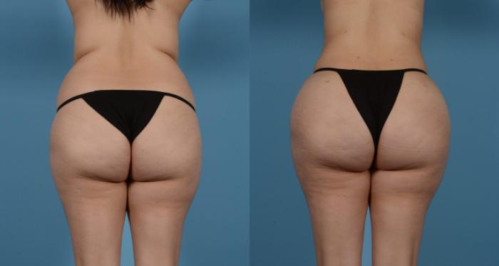 Before & After Brazilian Butt Lift Case 61387520 View 1 View in Houston, TX
