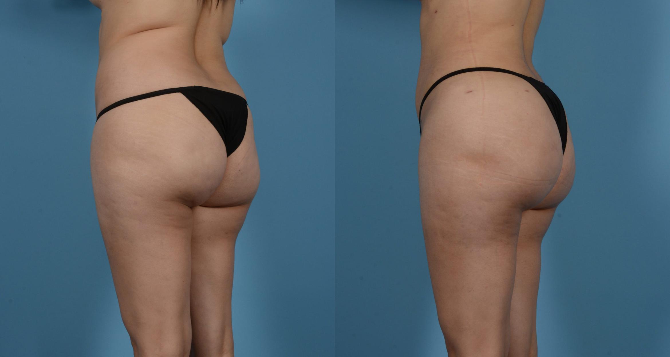 Before & After Brazilian Butt Lift Case 61387520 View 2 View in Houston, TX