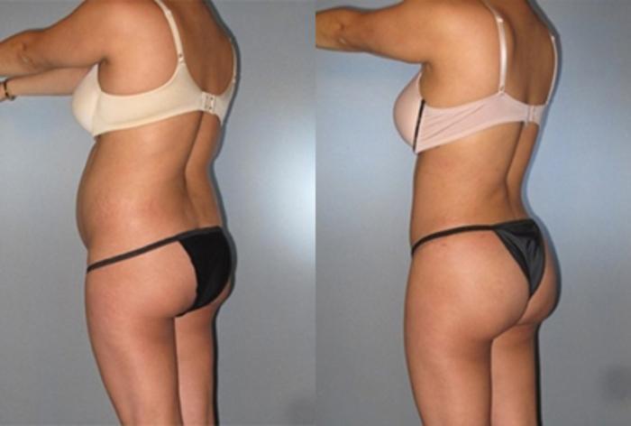 Before & After Brazilian Butt Lift Case 7776 View 1 View in Houston, TX