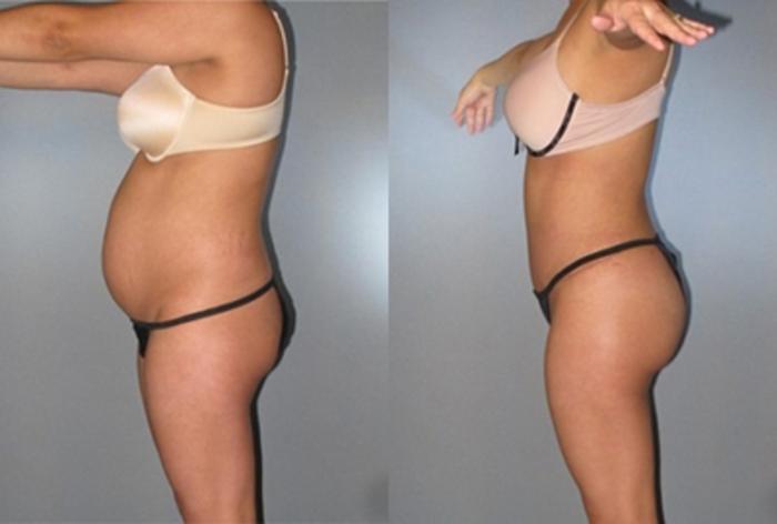 Before & After Brazilian Butt Lift Case 7776 View 2 View in Houston, TX