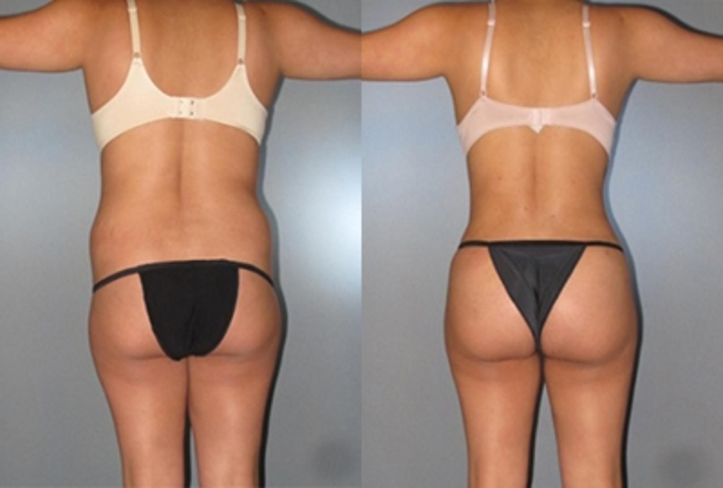 Before & After Brazilian Butt Lift Case 7776 View 3 View in Houston, TX