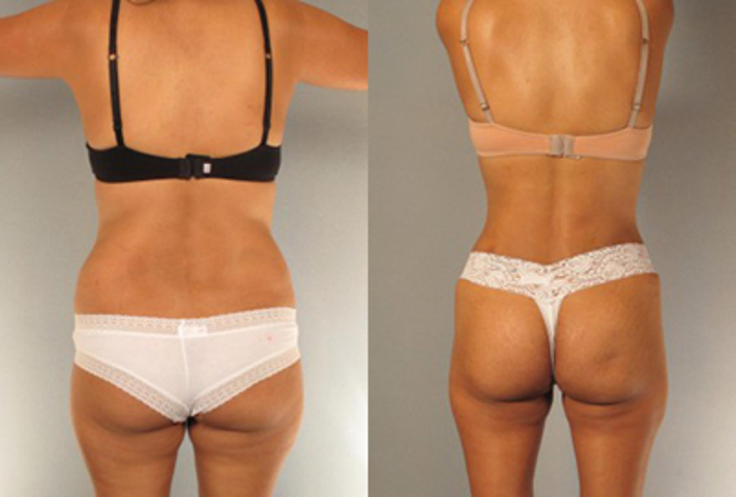 Before & After Brazilian Butt Lift Case 7795 View 1 View in Houston, TX