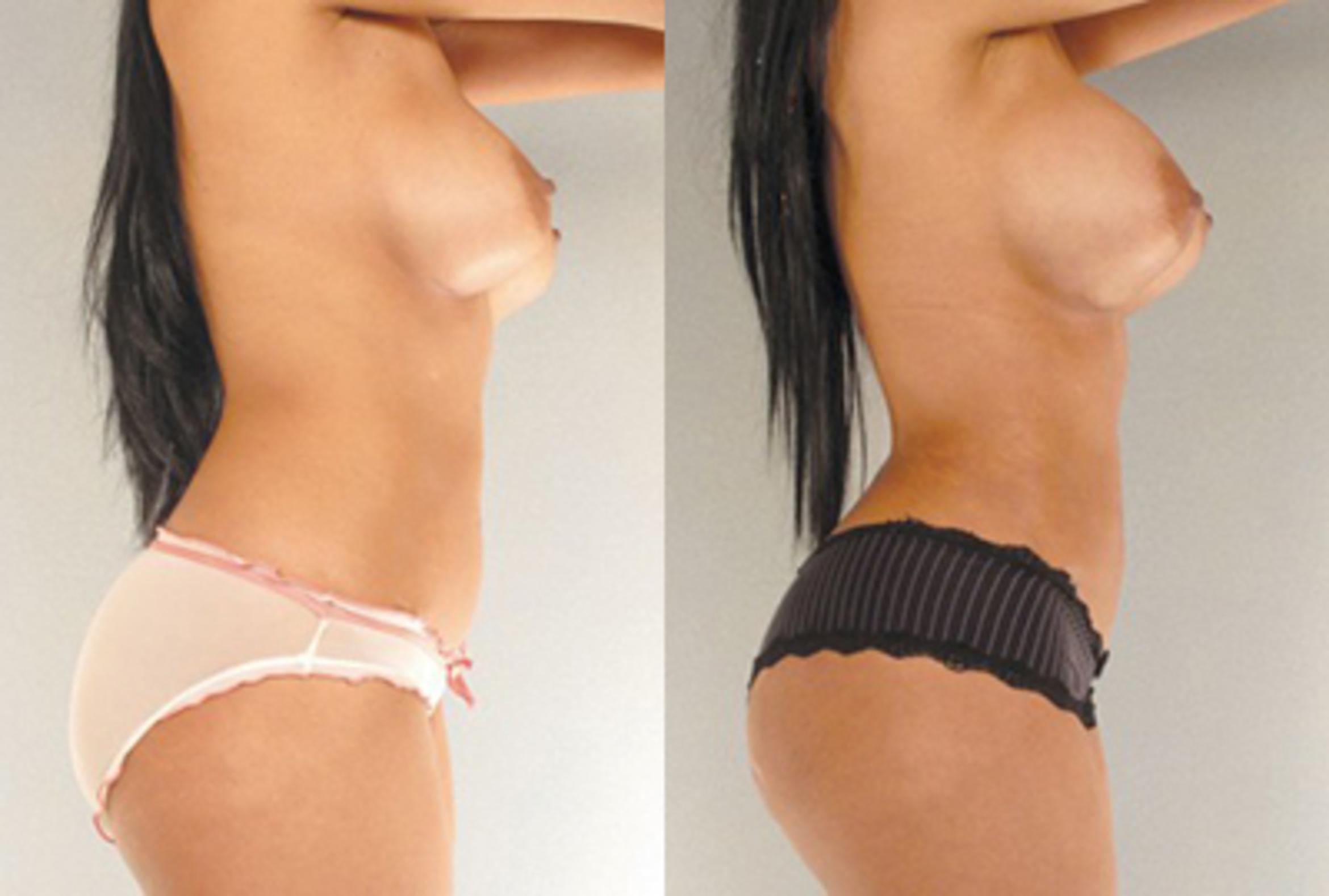 Before & After Brazilian Butt Lift Case 7805 View 1 View in Houston, TX