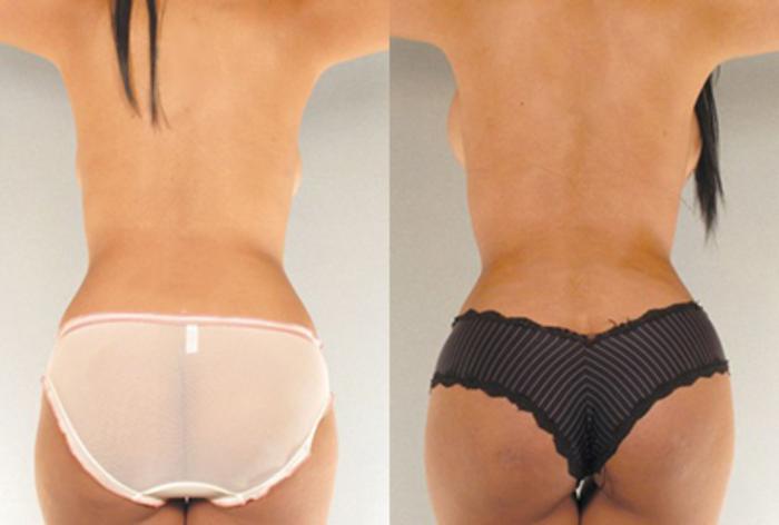 Before & After Brazilian Butt Lift Case 7805 View 2 View in Houston, TX