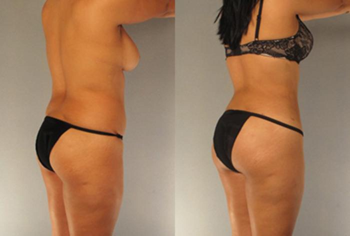Before & After Brazilian Butt Lift Case 7815 View 1 View in Houston, TX