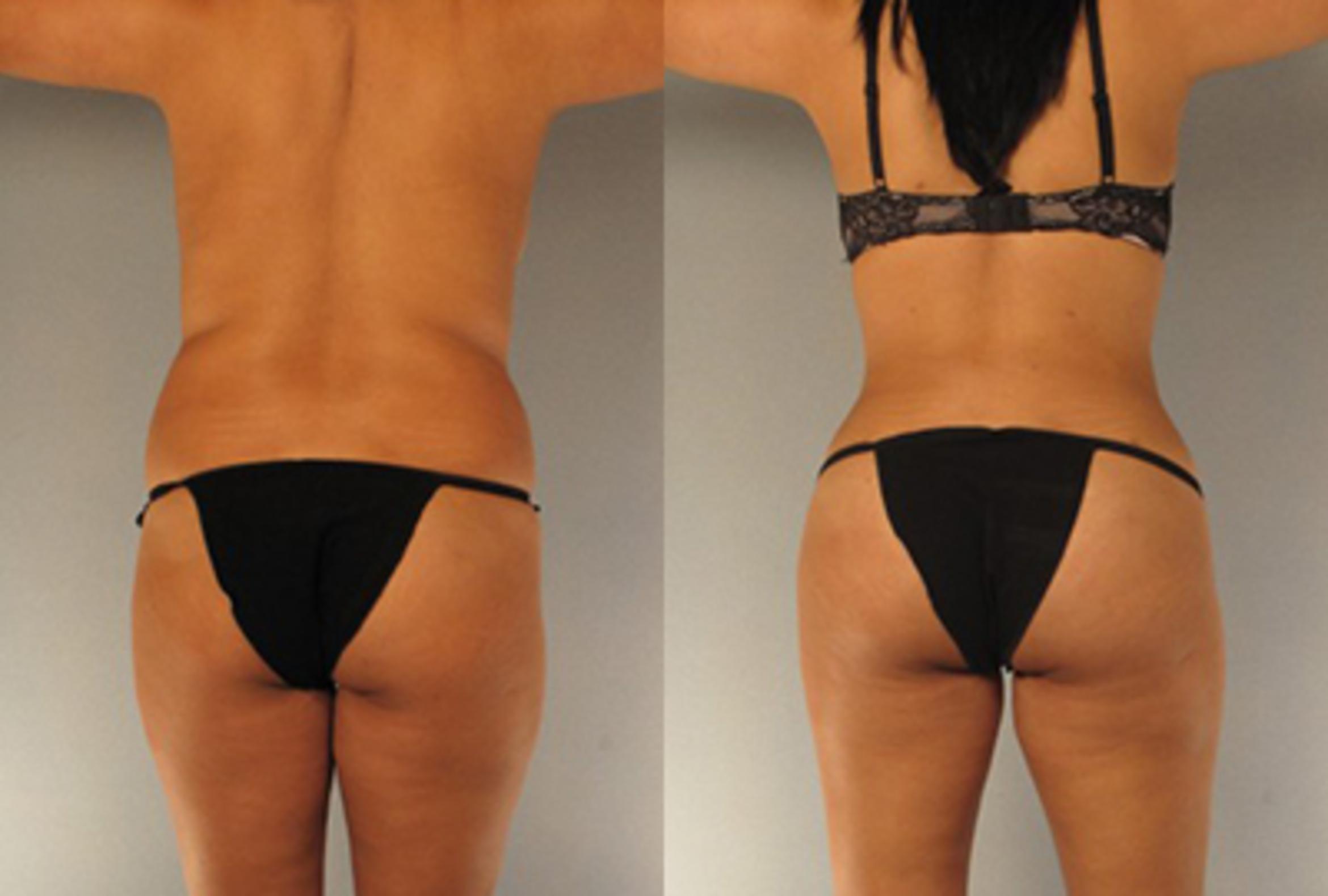 Before & After Brazilian Butt Lift Case 7815 View 2 View in Houston, TX