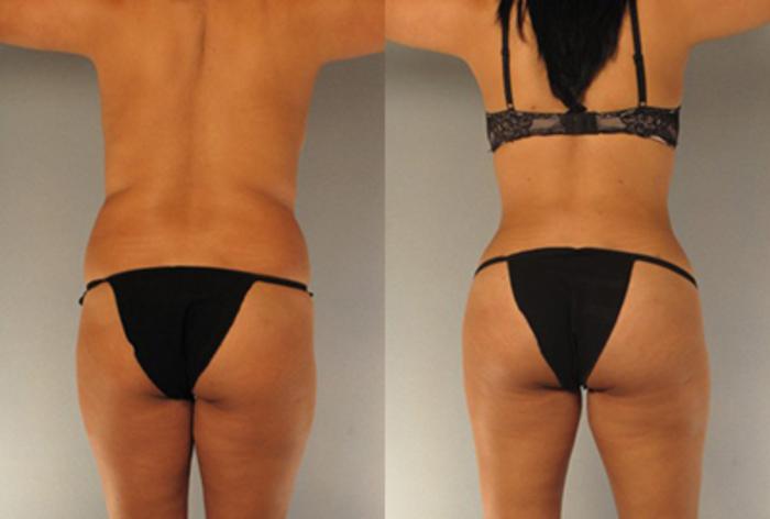 Before & After Brazilian Butt Lift Case 7815 View 2 View in Houston, TX