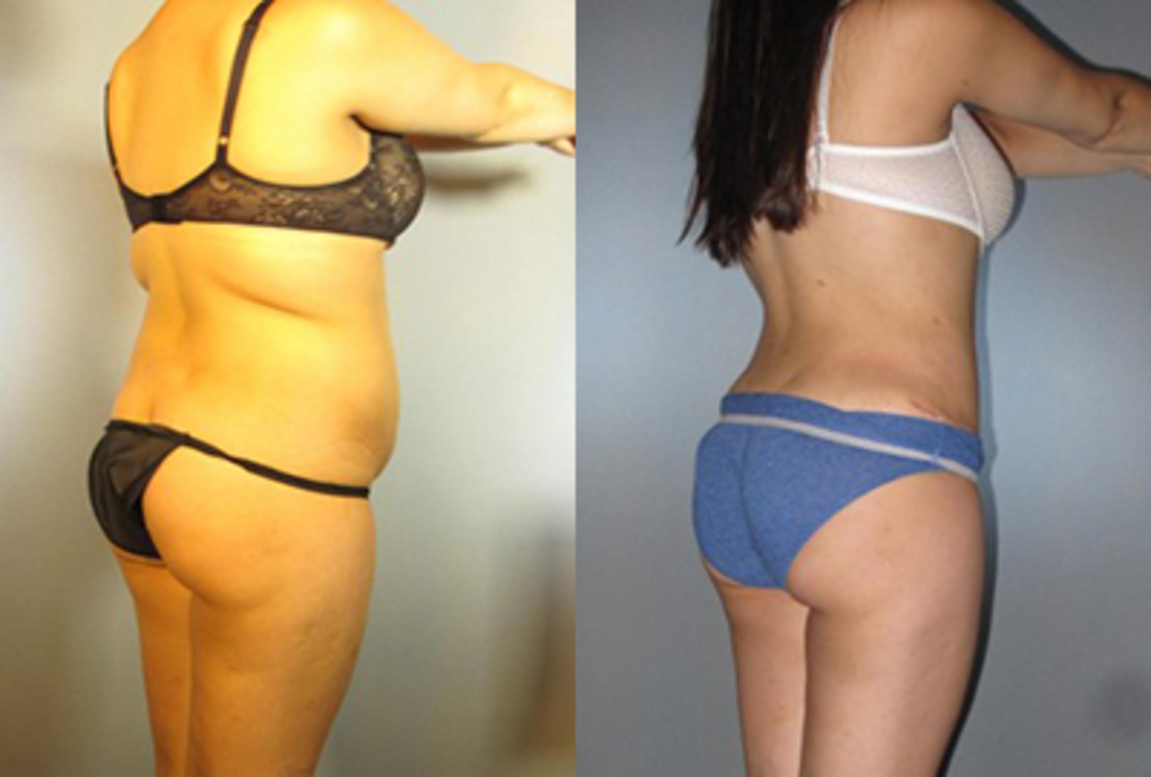 Before & After Brazilian Butt Lift Case 7828 View 1 View in Houston, TX