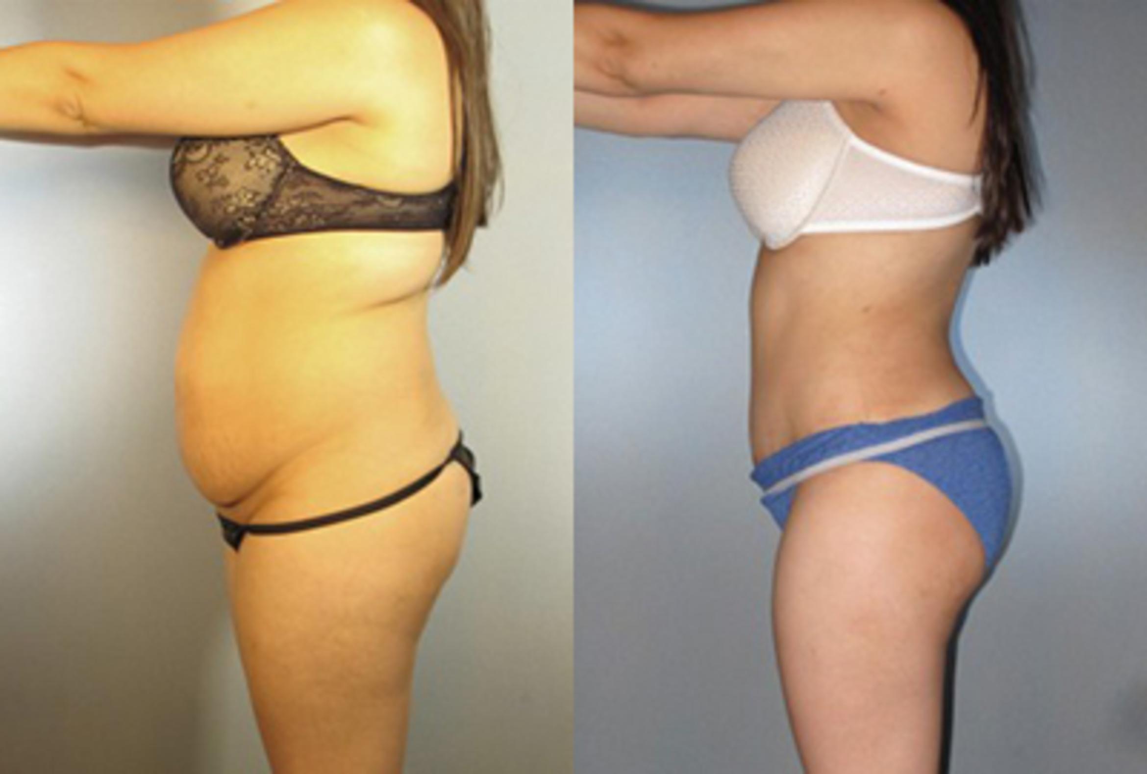 Before & After Brazilian Butt Lift Case 7828 View 2 View in Houston, TX